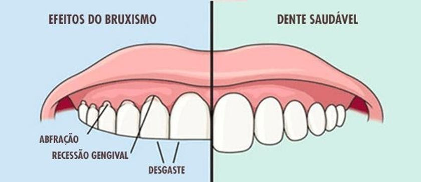 O Bruxismo Desvendado: Uma Profunda Exploração do Ranger de Dentes e suas Soluções na Fisioterapia ATM