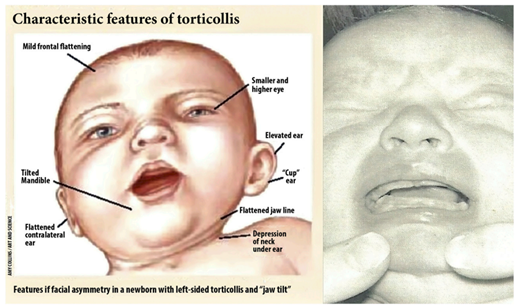 Osteopatia e Torcicolo Congênito Muscular